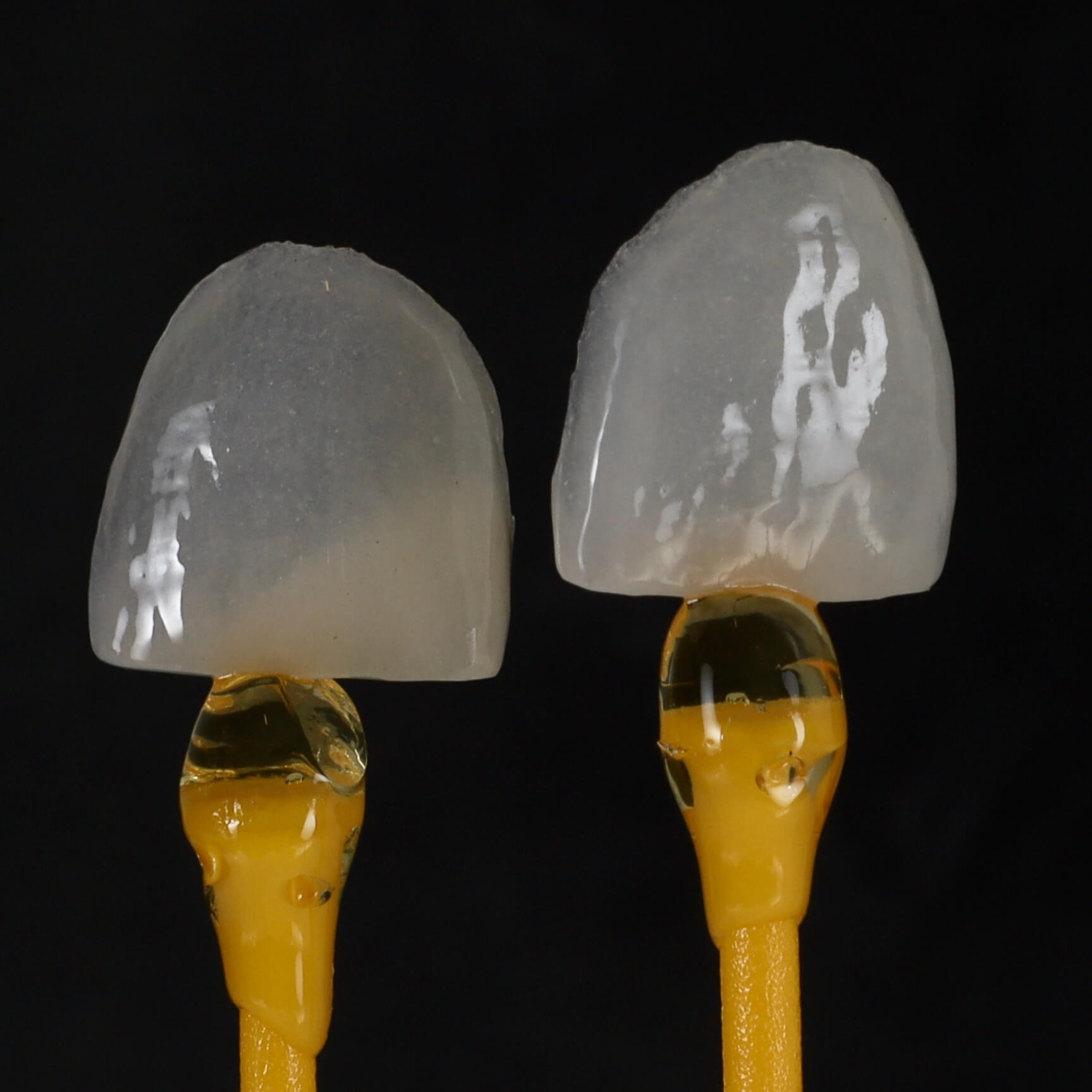 Szupervékony földpát kerámia héjak frontfogakra