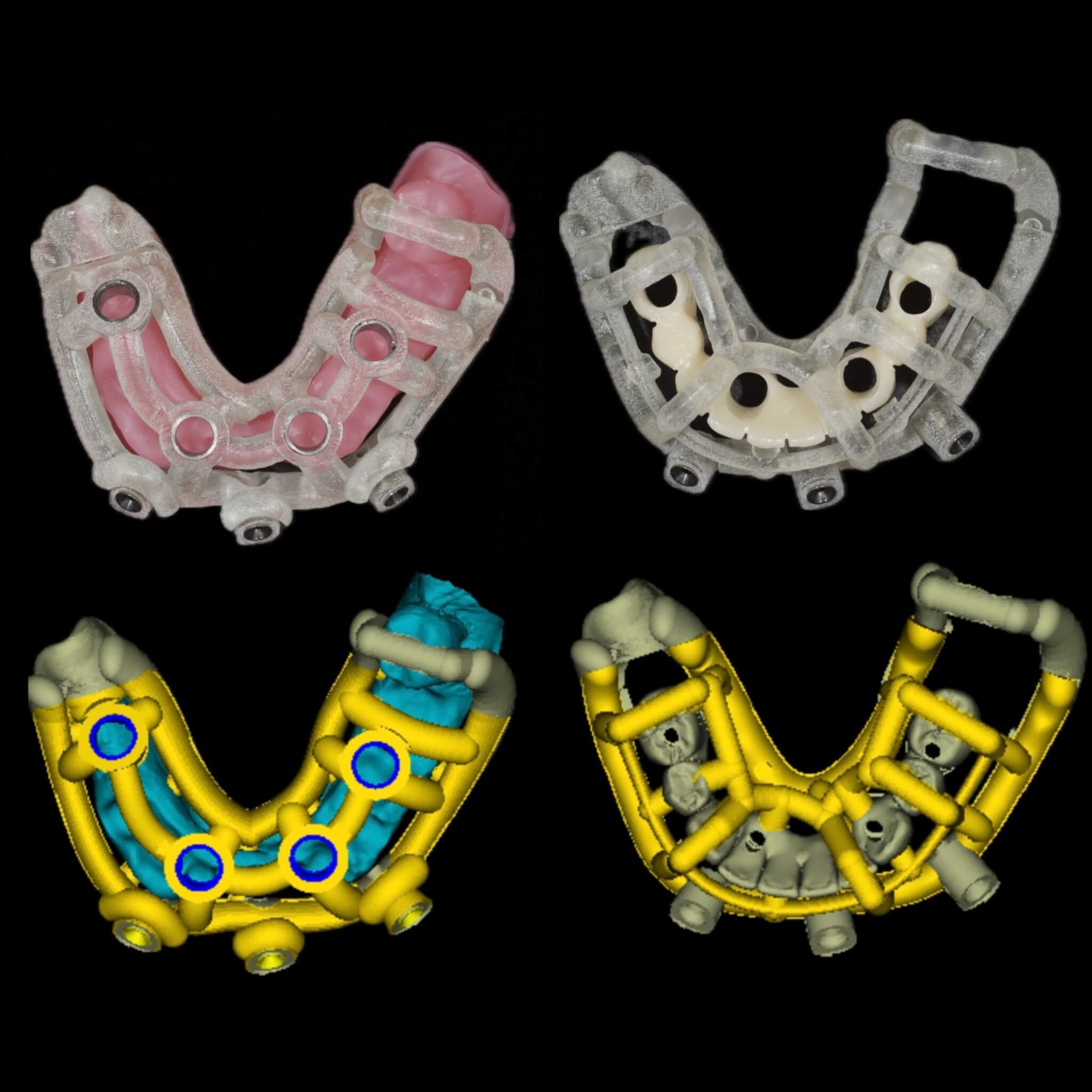 3D nyomtatott stackable guide sebészi fúrósablonok fogászati implantációhoz