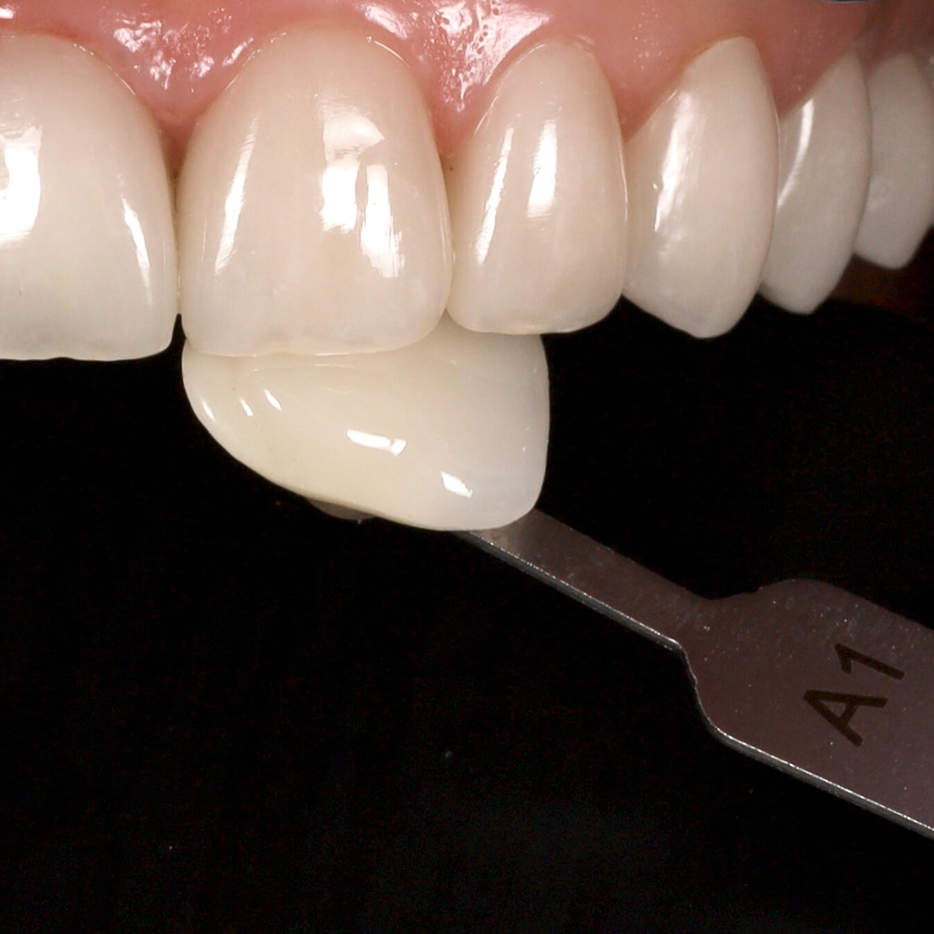 Természetes hatású Emax héjak és koronák