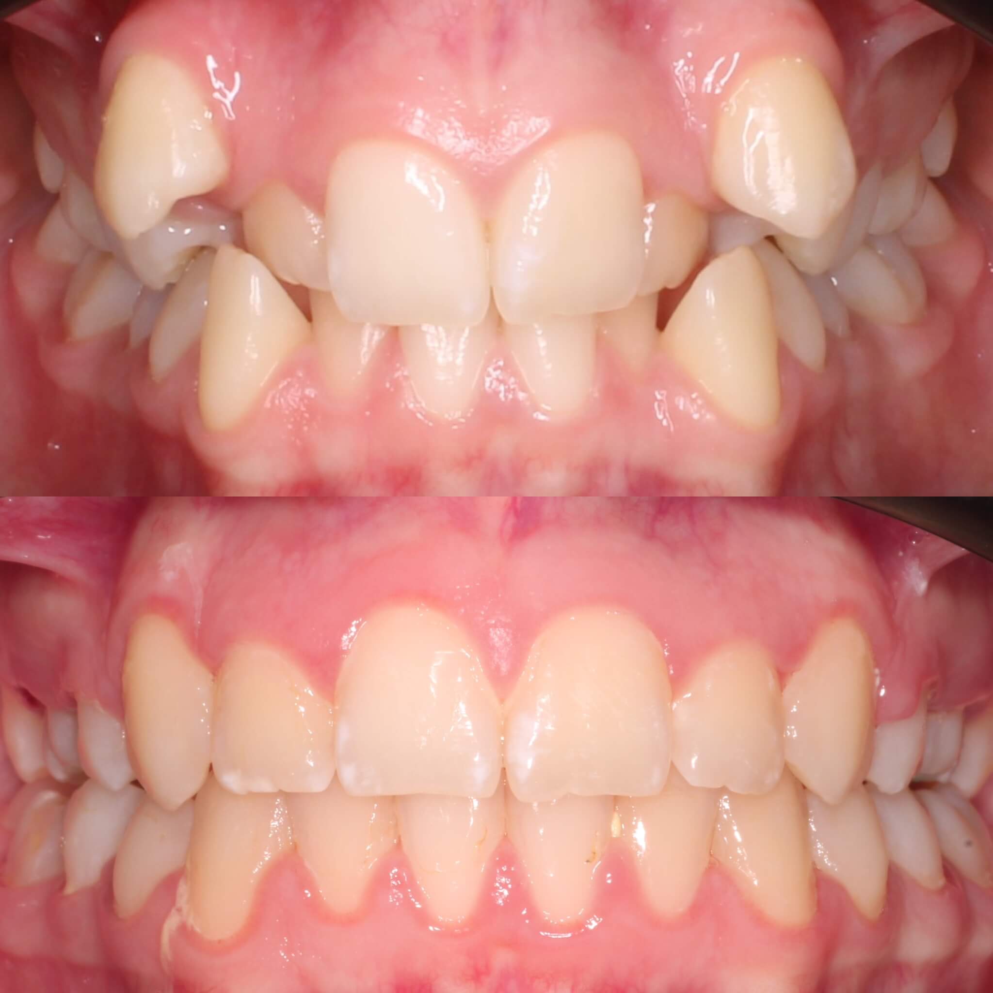 Aligneres fogszabályzás előtt után Dr Benedikti Bence