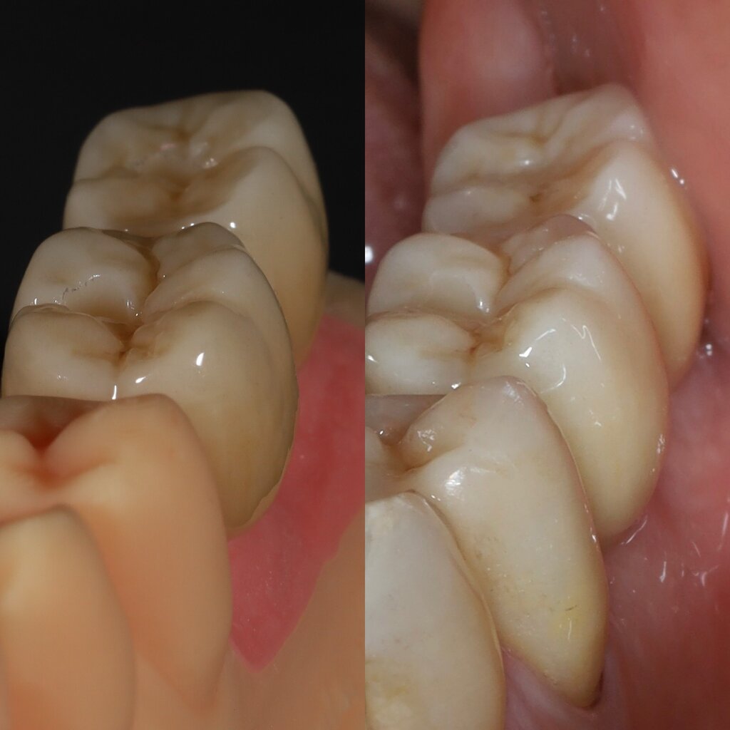 Élethű koronák fogászati implantátumokra digitális technológiával