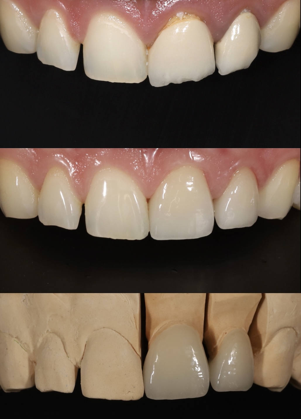 Régi pontatlan koronák cseréje élethű Emax koronákra eőtt-után, Smile Harmony Dental, Budapest