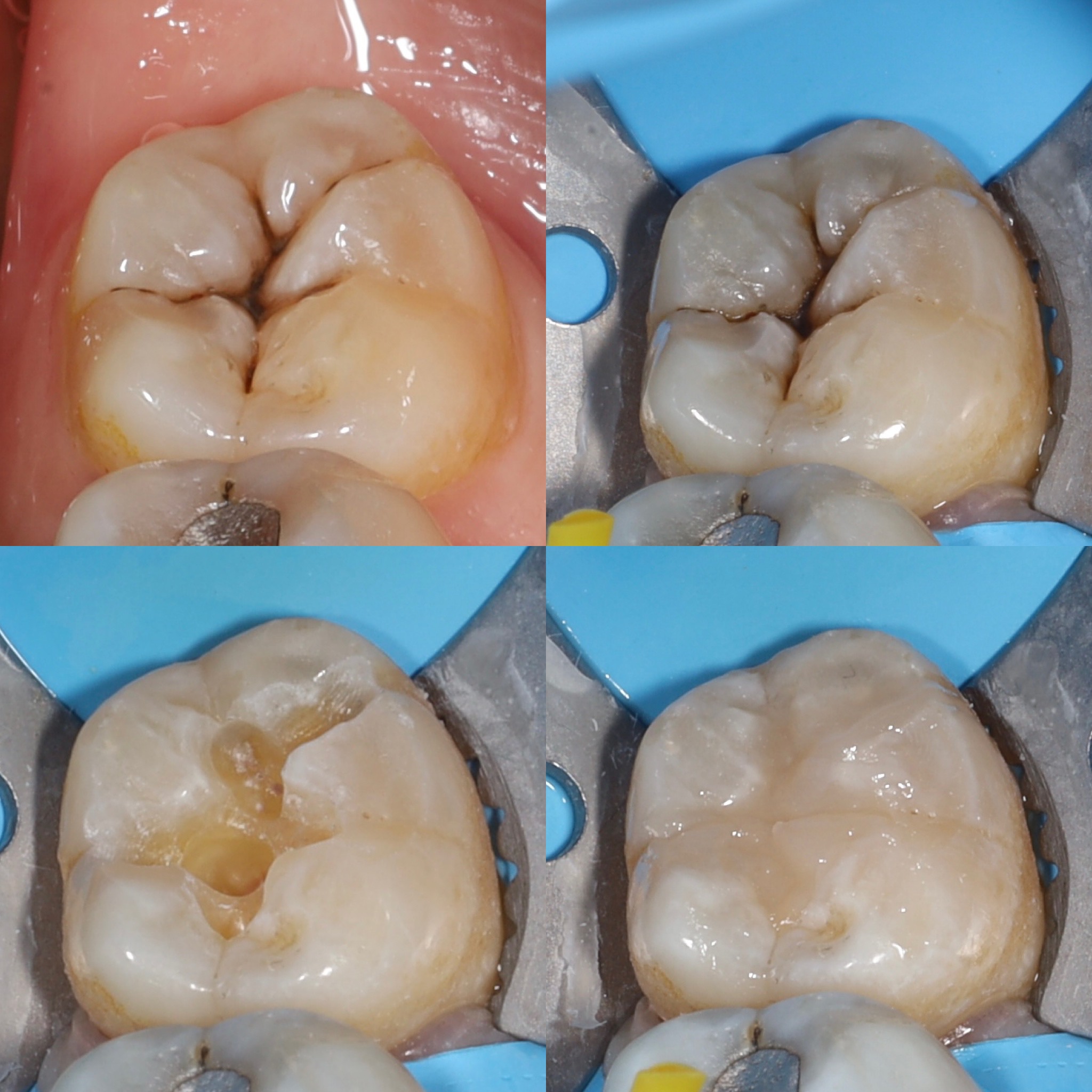 Kompozit tömés ecsettechnikával Tokuyama Aesteria tömőanyaggal
