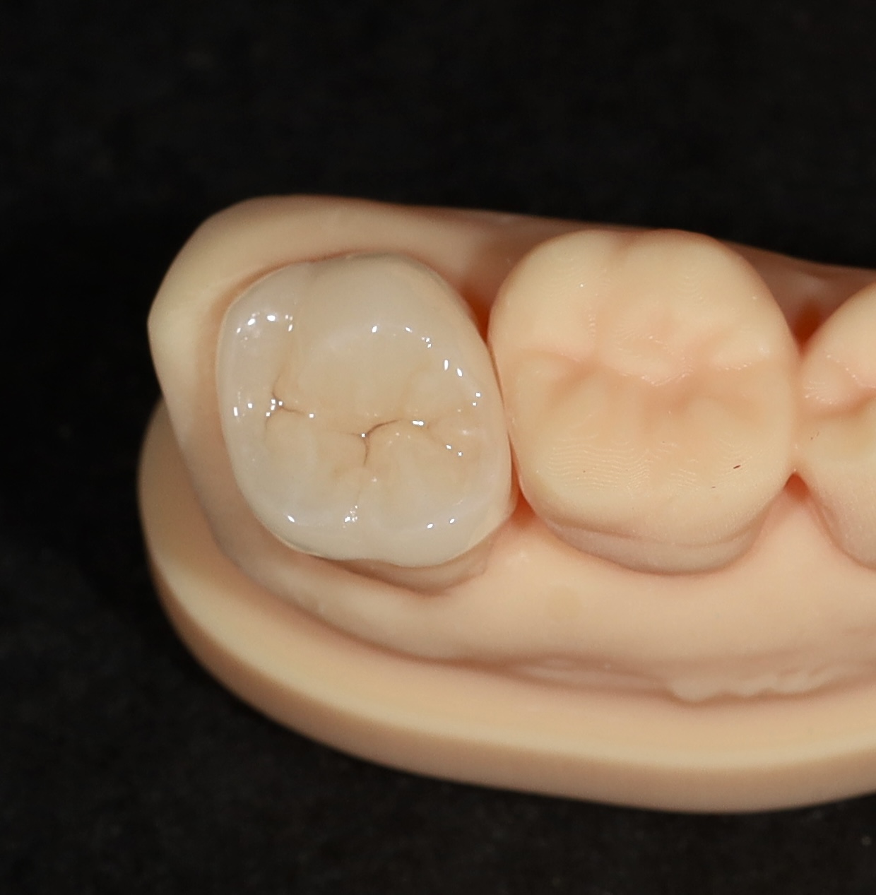 Scanneléssel és 3d nyomtatással készült préskerámia onlay fogpótlás