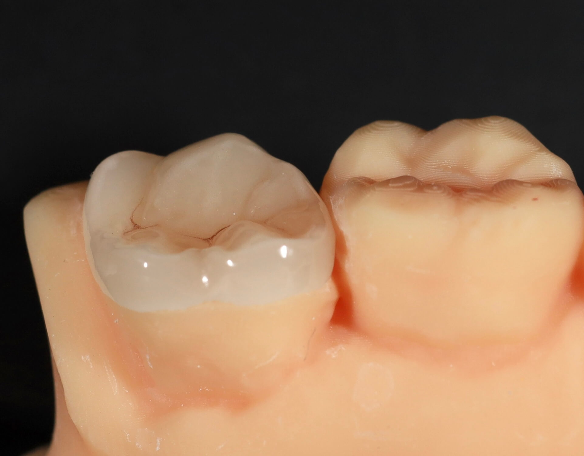 Scanneléssel és 3d nyomtatással készült onlay fogpótlás
