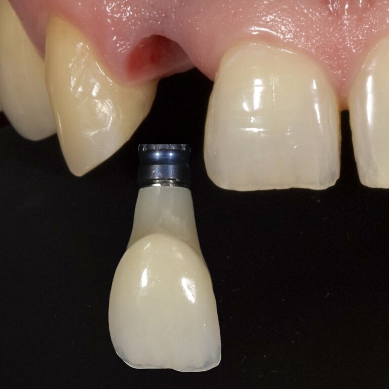 Implantátumra készült fémmentes cirkónium korona