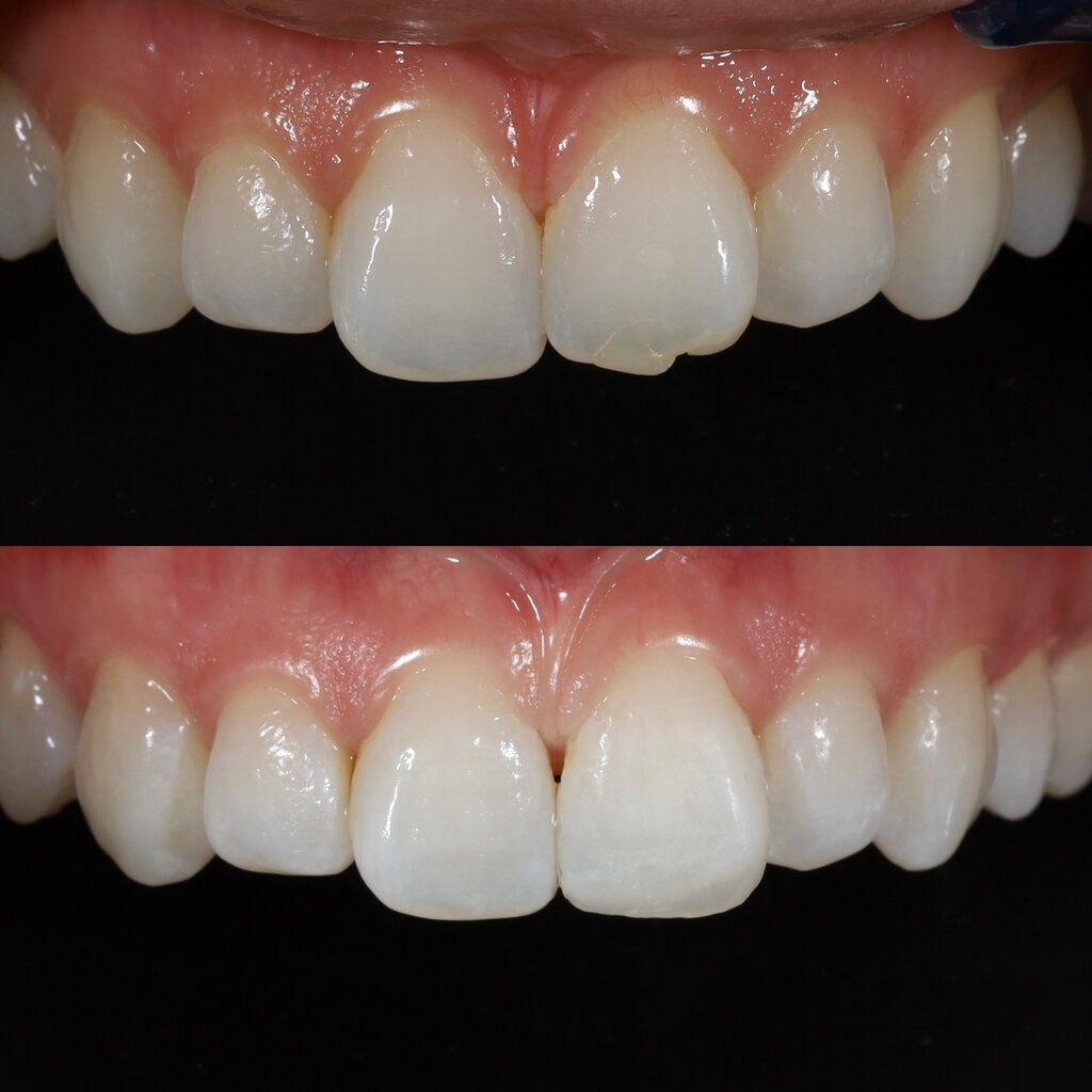 Nonprep héj before-after