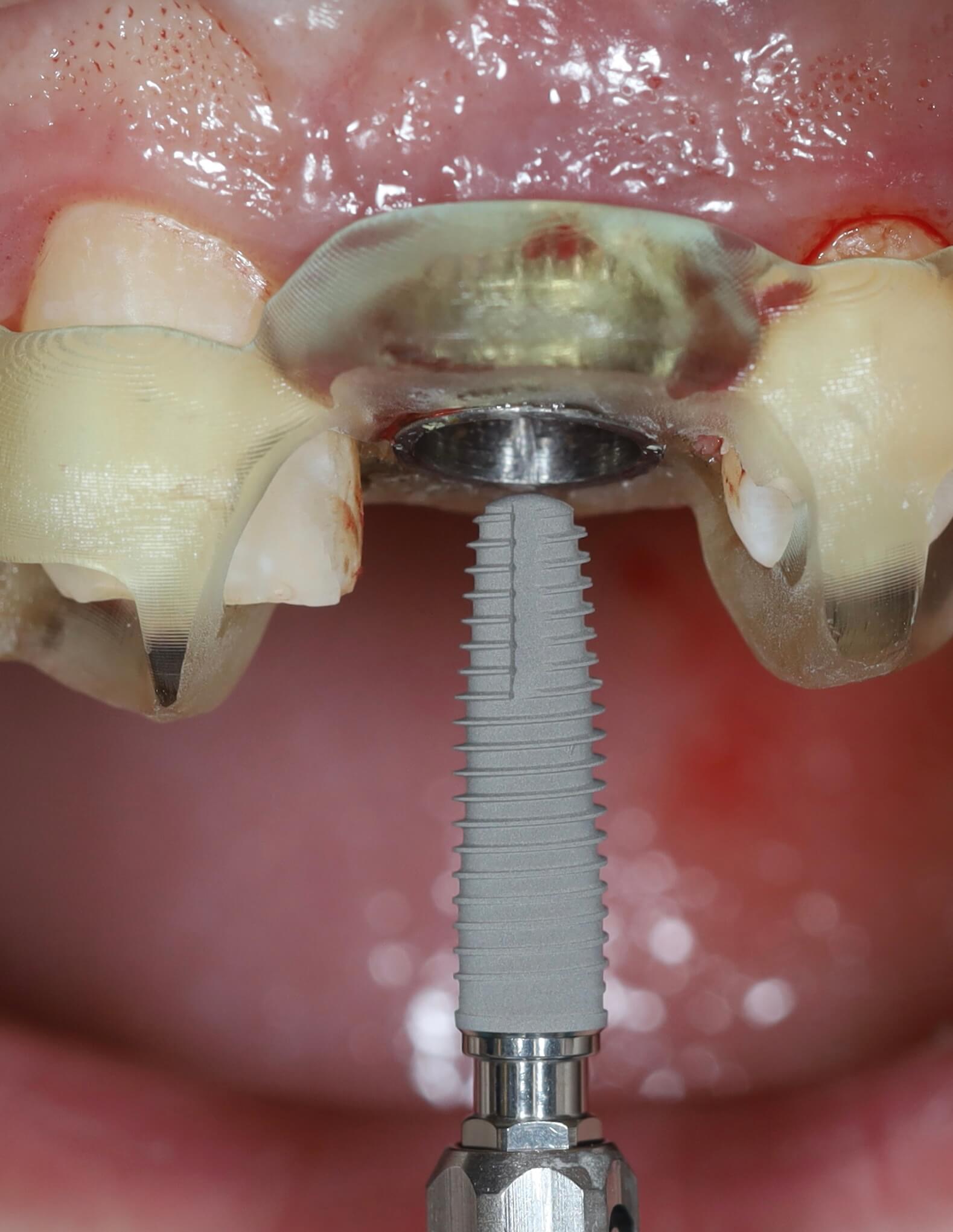 Implantátum behelyezés 3D navigációval