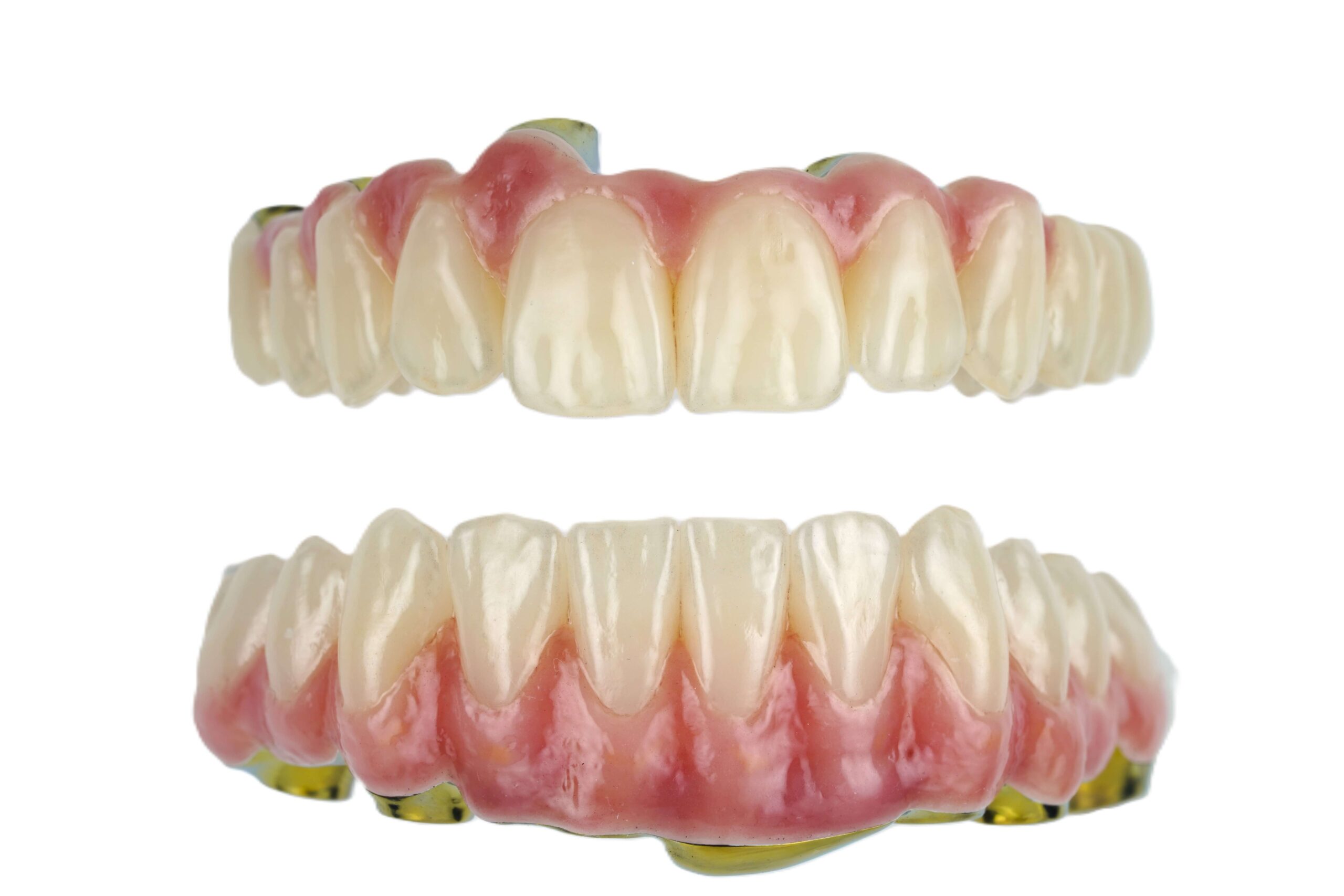 Smile design 3D CAD-CAM implant fogpótlások