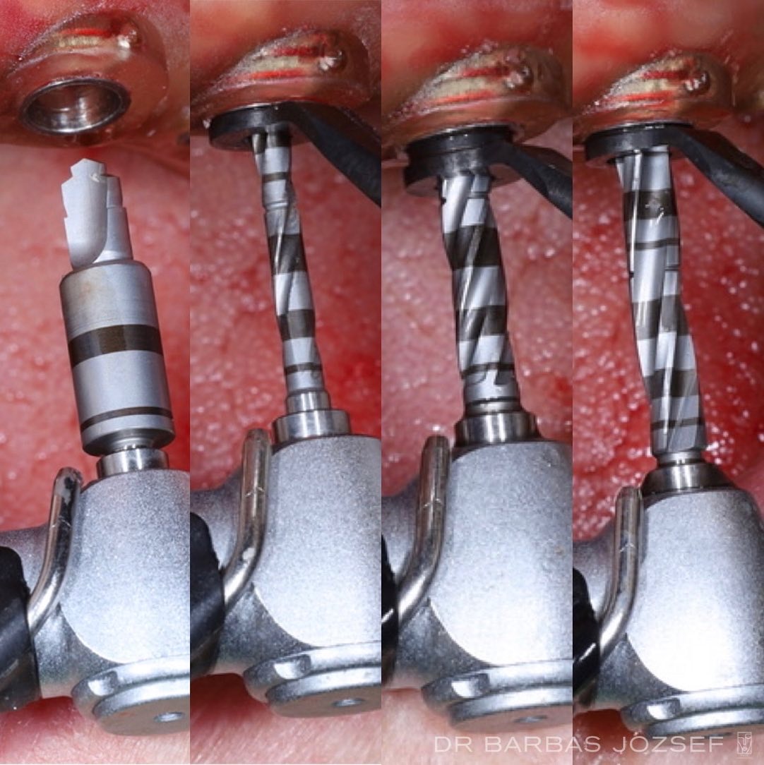 SIC Invent implantátum beültetés 3D nyomtatott sebészi sablon segítségével