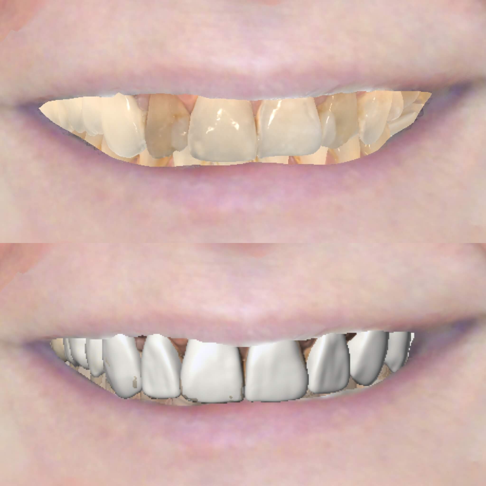 Digitális 3D mosolytervezés implantátumra