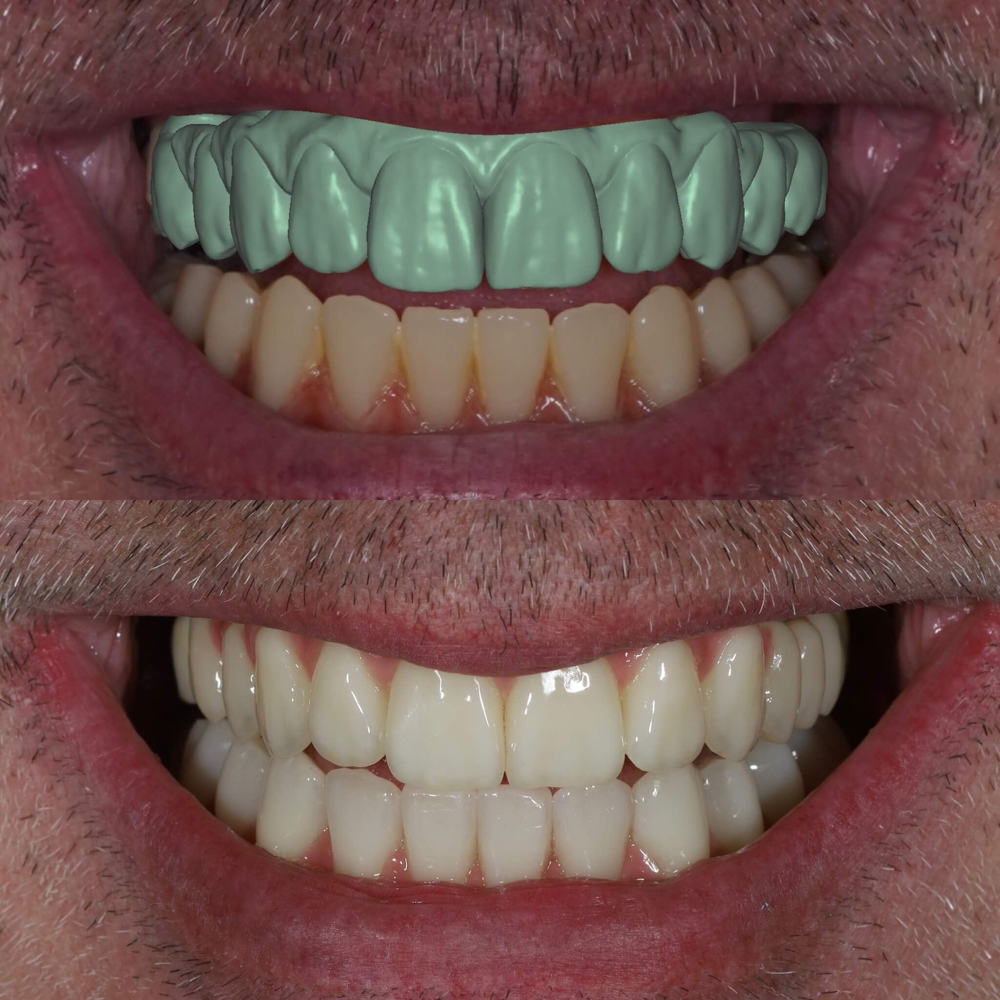 Teljes állcsont rehabilitáció implantátumokkal digitális műtéti tervezés