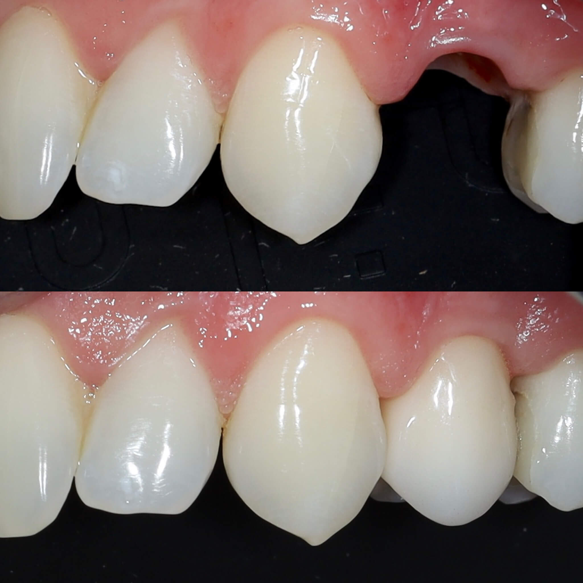 Azonnali implantációval pótolt kisőrlő eőtt-után