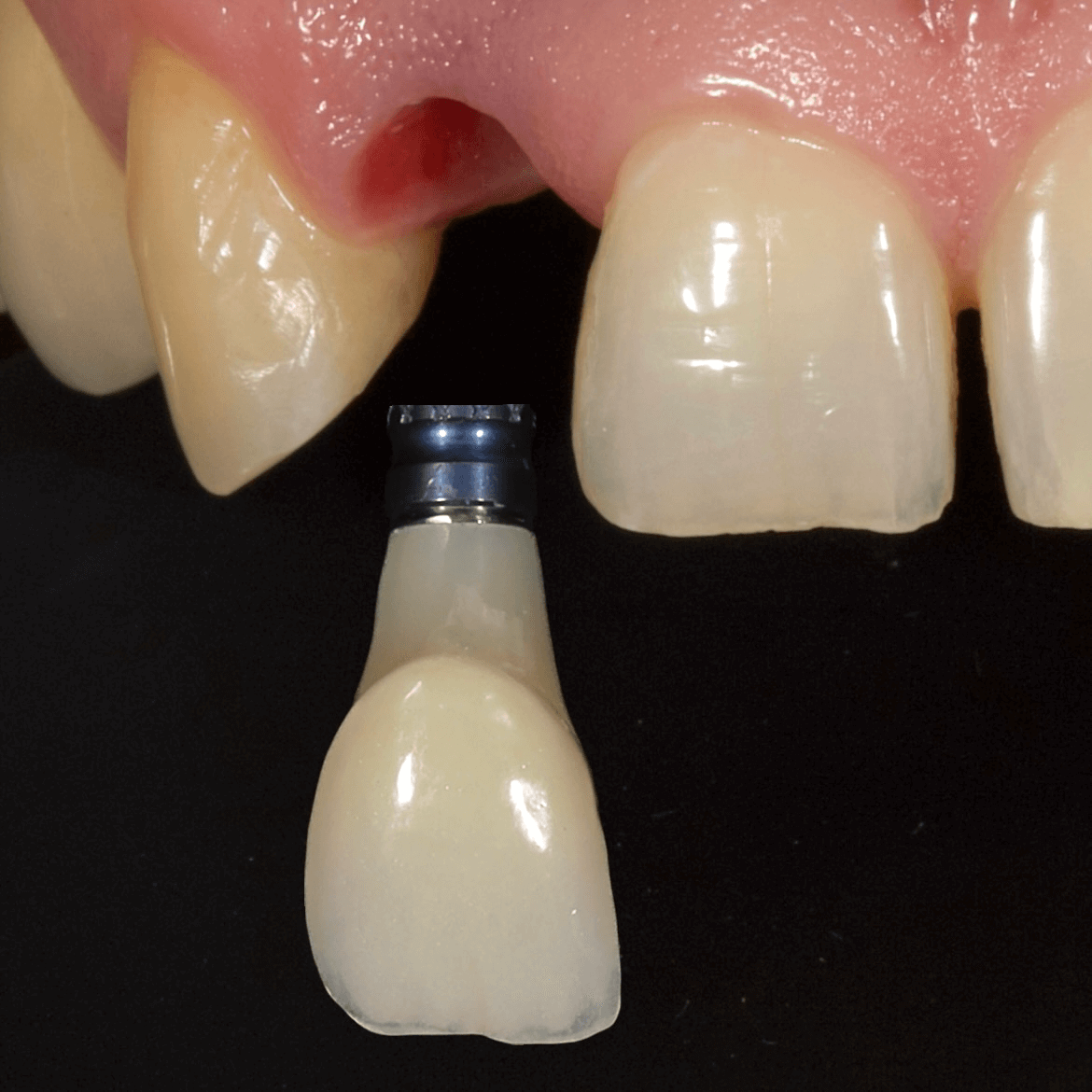 Azonnali implantációval pótolt kisőmetsző előtt-után