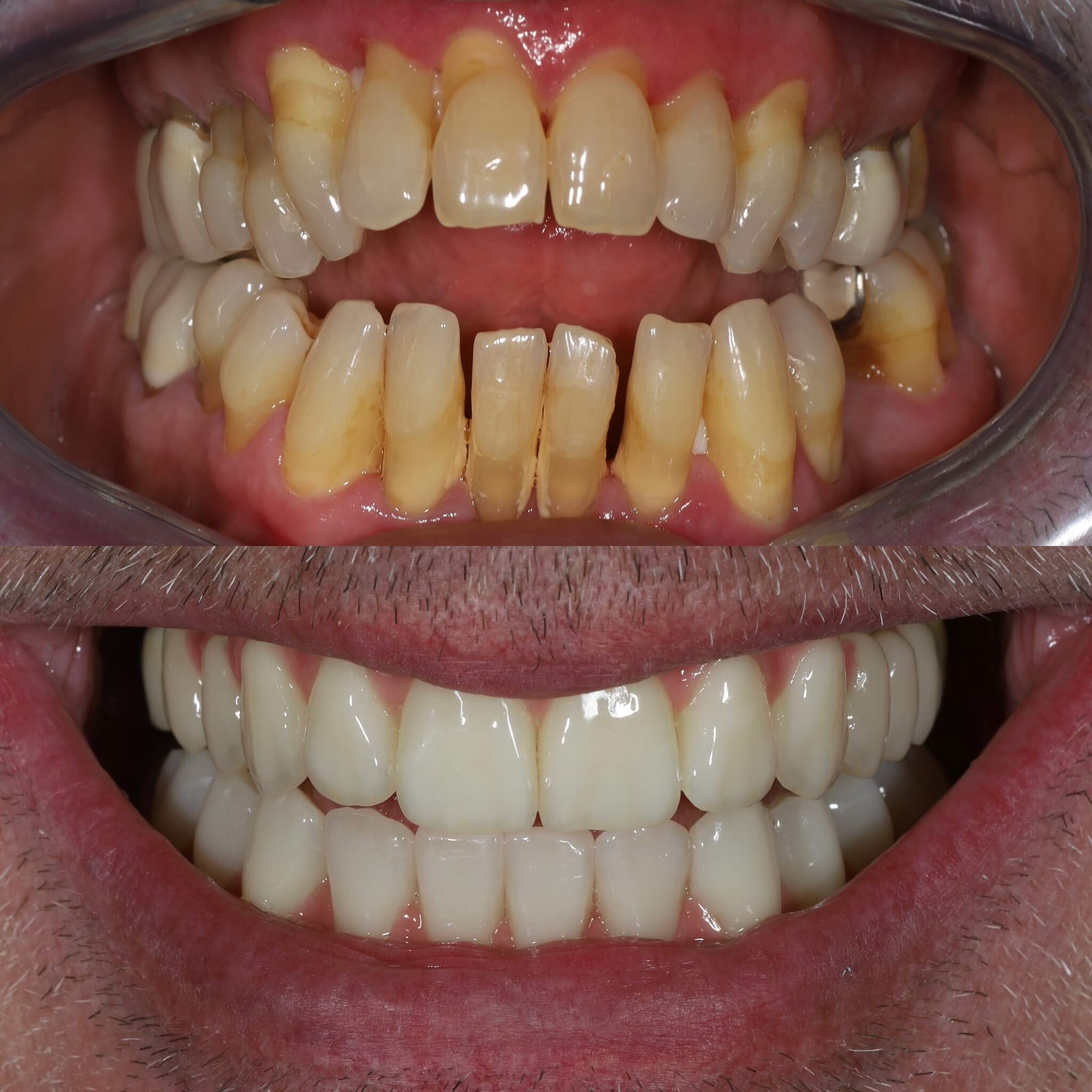 Teljes szájrehabilitáció stackable guide technológiával